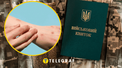 Чи мобілізують чоловіків із хворою шкірою?